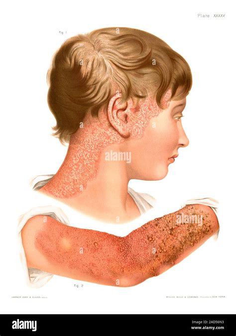 Eczema Historical Medical Illustration Of Cases Of Eczema On The Neck
