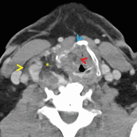 Neck Ct Scan With Contrast Showed A Right Thyroid Mass Arrowheads