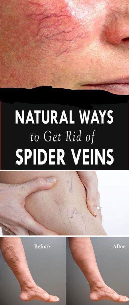 Natural Home Remedies To Get Rid Of Spider Veins Beauty H4