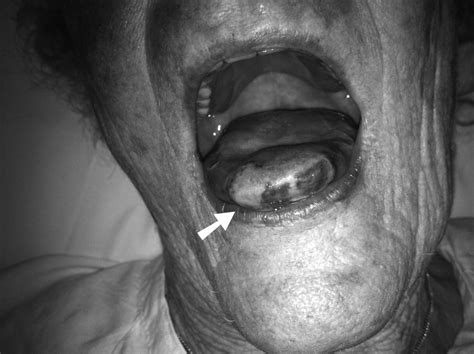 Necrotic Tongue A Rare Manifestation Of Giant Cell Arteritis The