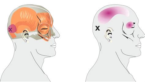 Tension Headaches Spine Plus