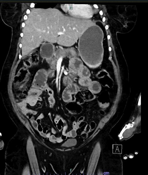 Small Bowel Obstruction In The Virgin Abdomen Surgical Clinics