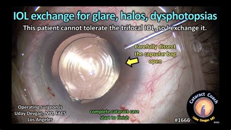 Cataractcoach Iol Exchange For Glare Halos Dysphotopsias Youtube