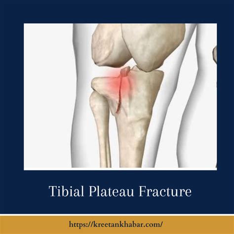 Tibial Plateau Fractures Causes Symptoms And Treatment Kreetan