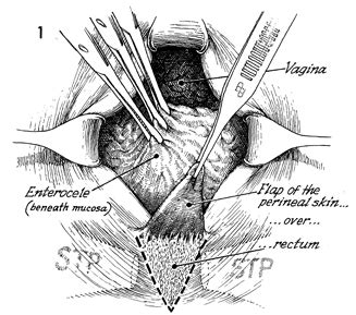 Vaginal Repair Of Enterocele
