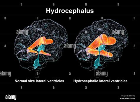 Enlarged And Normal Brain Lateral Ventricles Illustration Stock Photo