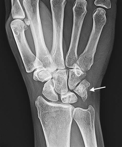 Woman With Wrist Pain After Falling Annals Of Emergency Medicine