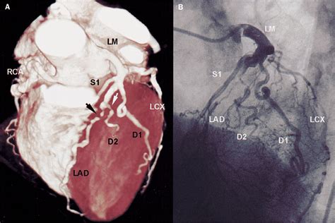 Coronary Angiography With Multi Slice Computed Tomography The Lancet