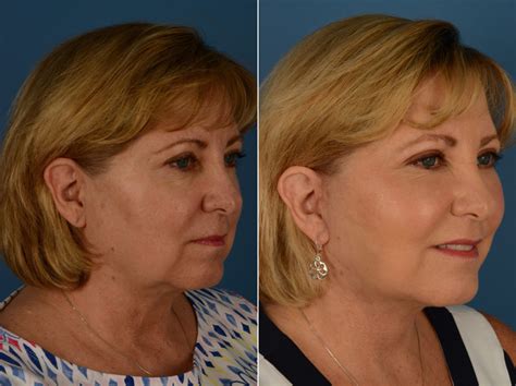 The Uplift™ Lower Face And Neck Lift Photos Naples Fl Patient 14428