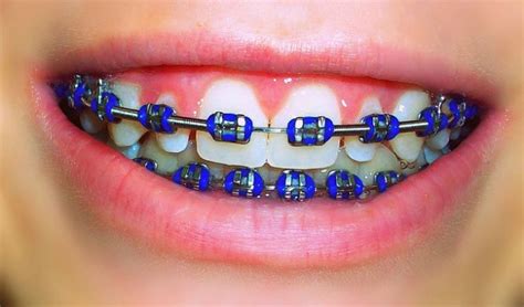 Orthodontic Alloys What Are Braces Made Of Orthodontics In London