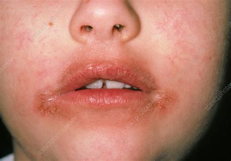 Dermatitis Around The Mouth Of A Child Stock Image M1400153