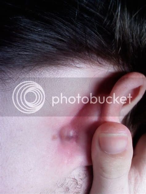 Black Bump On Back Of Ear Skin Forum Conditions And Diseases