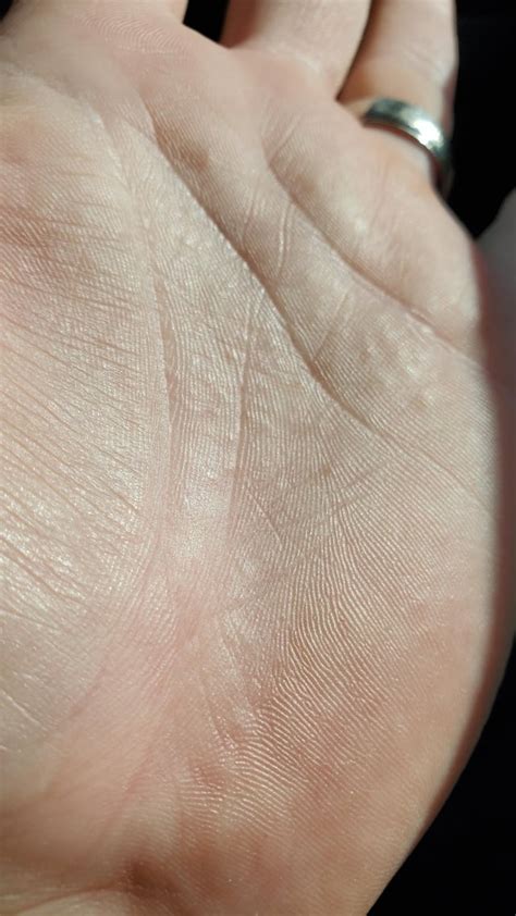 These Little Bumps Appeared On My Finger Yesterday And On My Palm This
