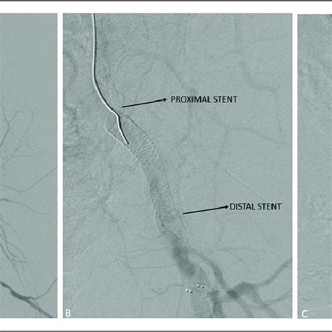 Single Stent Jailed Profunda Femoral Artery In A 59 Year Old Female
