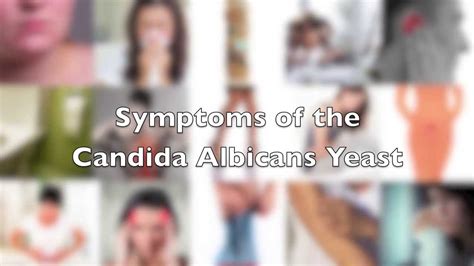 Episode 11 The Full List Of Candida Albicans Symptoms Youtube