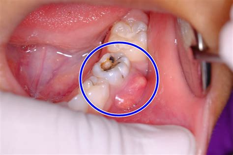 Tooth Abscess Symptoms Causes And Treatment Ilajak Medical