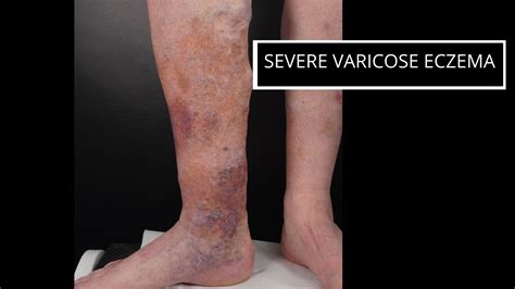 Varicose Eczema The Veincare Centre
