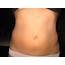 Tips To Remove Abdominal Distention  Health Care Skin Beauty