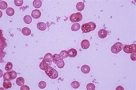 The bacteria can cause middle ear infections, sinusitis, and more serious infections, including meningitis. Haemophilus aegyptius: Description of pathogen