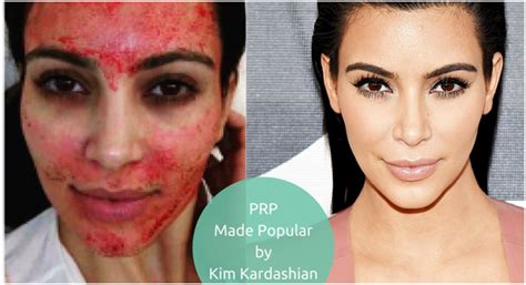 Prp with microneedling can eliminate fine lines and wrinkles, remove scars, shrink pores, and produce an overall healthier glow. What is a "Vampire Facial"? - Medical Spa & Cosmetic Center