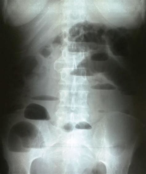 Plain Abdominal Radiography Showing Air Fluid Levels Download