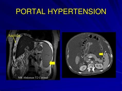 Portal Hypertension Radiological Diagnosis And Interventions