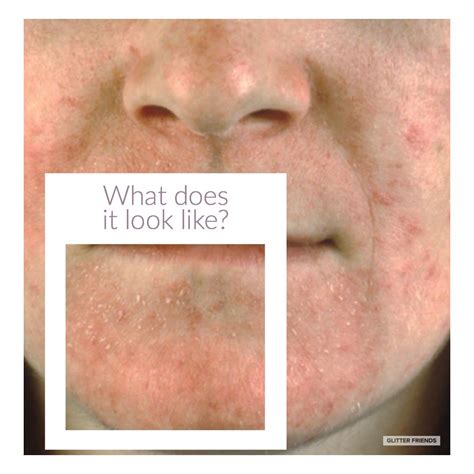 What Does Perioral Dermatitis Look Like Skin Eczema Dry Skin Eczema