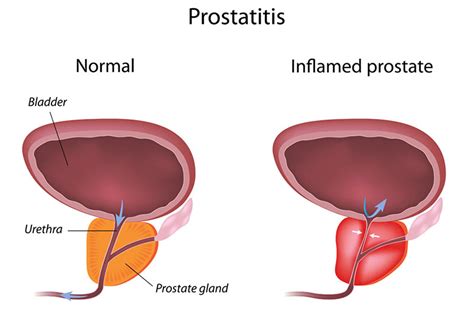Prostatitis And What You Need To Know Urology Specialist