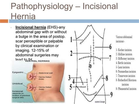 Incisional Hernia