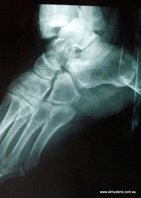 Compound Ankle Fracture Xrays