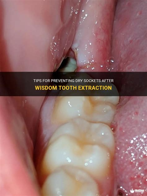 Tips For Preventing Dry Sockets After Wisdom Tooth Extraction Medshun