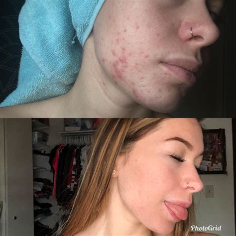 Week 3 On Accutane This Is Before And After Accutane I Had Awful
