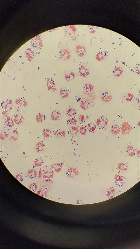 Gram Positive Coccobacilli In The Csf Of A 11 Day Old Nicu Patient R