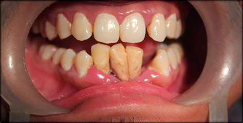This enamel is made up of minerals that can be damaged by bacteria (demineralization) through acids which causes cavities and other dental problems. LOOSE BOTTOM FRONT TEETH-Treatment by affordable dental ...