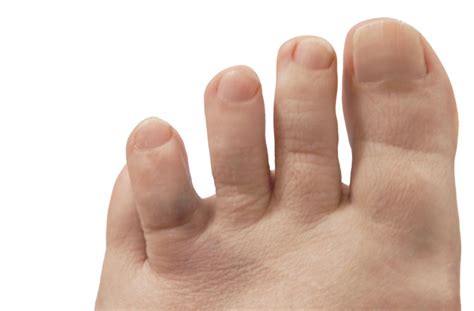Maybe you would like to learn more about one of these? Broken toe: Symptoms, pictures, and treatment