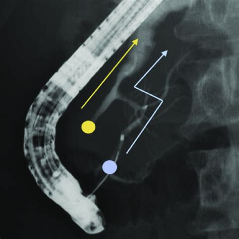 A Endoscopic Minor Papillotomy B Endoscopic Minor Papilla Balloon