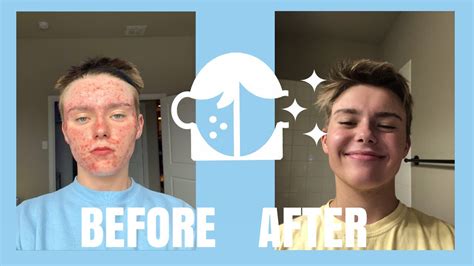 Accutane Journey My Experience Youtube