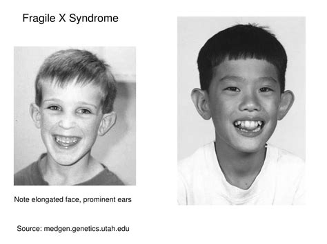 Ppt Fragile X Syndrome Powerpoint Presentation Free Download Id340722