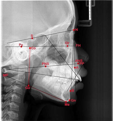 Landmarks Of Cephalometric X Ray Abbreviations Of Fig 2 Pns Download Scientific Diagram