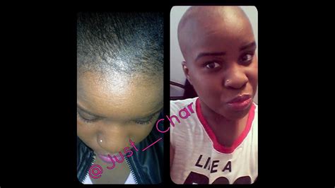 Otherwise, lack of nutrients including androgens can lead to the hair loss. How To: Combat/Cure Alopecia Hair Loss With Biotin ...