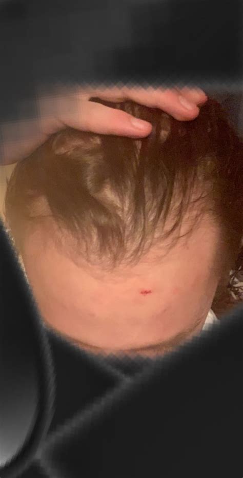 A receding hairline can start creeping backwards any time after the end of puberty, and will usually become noticeable by the time most men reach their if your receding hairline has been caused by an underlying medical issue, the most important thing to do is speak to your doctor, advises dr deo. Norwood 2 Or Just A Mature Hairline? (17 Years Old ...