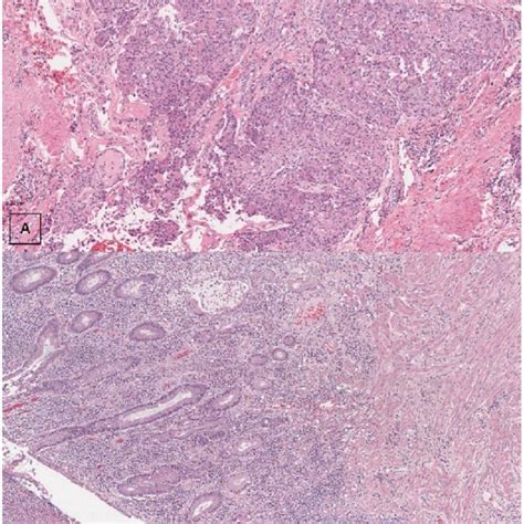 A Histological Image Of Transitional Cell Carcinoma And Atypical