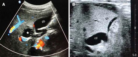 Cystic Malformation Of Cystic Duct 10 Cases And Review Of Literature