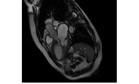 Coronal Section Of Cardiac Mri Showing Lvot Obstruction And Mitral