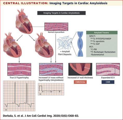 How To Image Cardiac Amyloidosis A Practical Approach Jacc