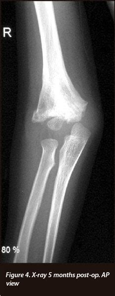 Ipsilateral medial and lateral condylar fracture of the ...
