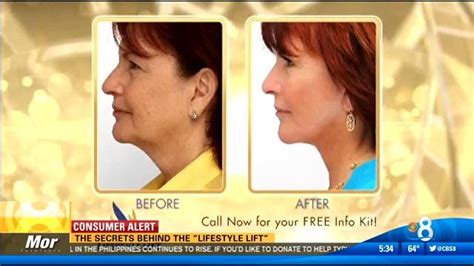 However, they are not associated with permanent, lasting results. The secrets behind the Lifestyle Lift - CBS News 8 - San ...