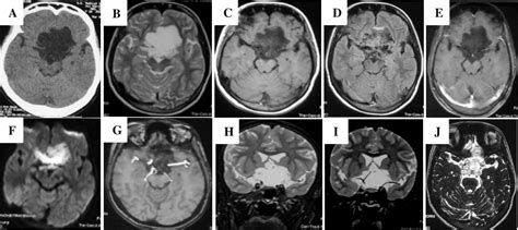 Figure 1 From Suprasellar Epidermoid Cyst A Rare Cause Of Painless