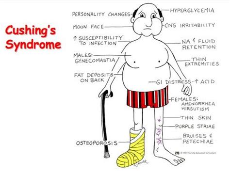 Cushing | Endocrine system, Endocrine, Gynecomastia