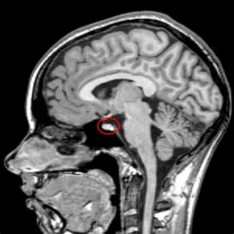 t1 weighted mri of her pituitary with contrast showing normal download scientific diagram